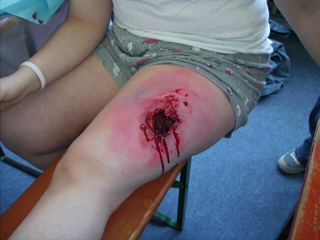 Meine Oberschenkelfraktur