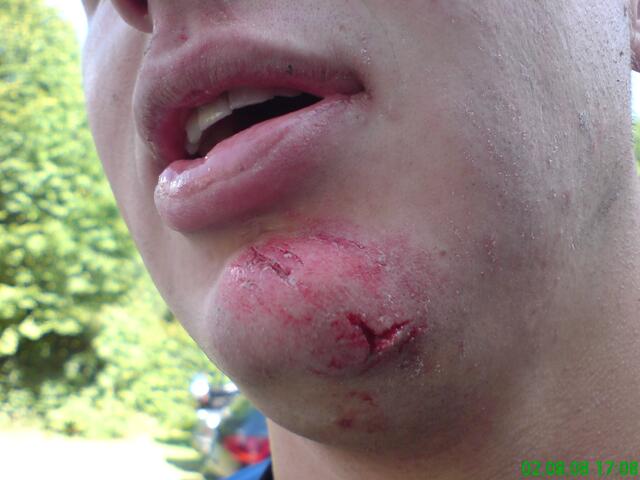 Nichts für schwache Nerven! Hat ganz schön geblutet.