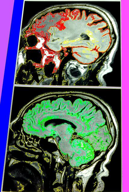 Neuro-Ästhetik bitte HANDELN. a&s-Selbstbespiegelung (MRT-Bild coloriert - 13/4/10).