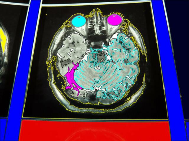 Für die Entstehung der Symptome der Parkinson-Krankheit sind die Nervenzellen der Substantia nigra (schwarze Substanz) von besonderer Bedeutung. Mittelhirn-a&s-p-malerei. wh 2-5-11.