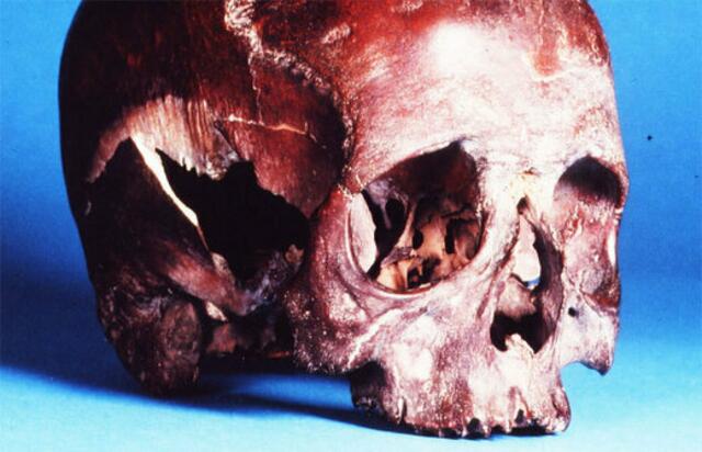 1878 fanden Arbeiter beim Bau von Zollanschlussbauten auf dem Grasbrook einen Schädel mit einem Loch in der Schädeldecke. Ein weiterer Schädel folgte, ebenfalls ohne weitere Skelettteile.