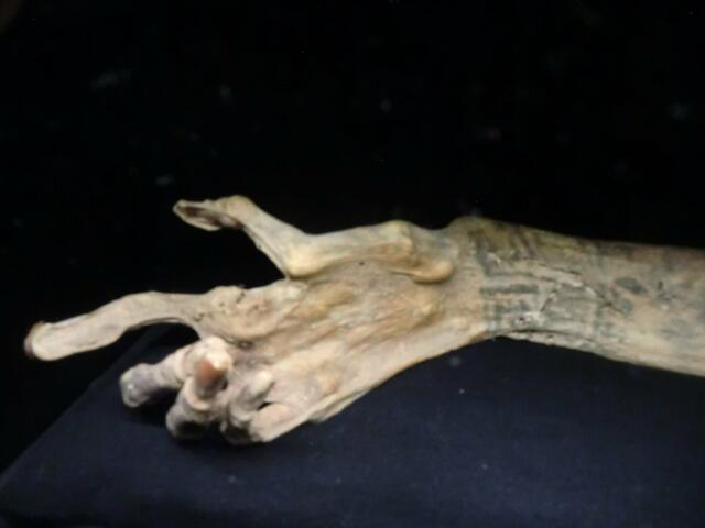 Ötzis Handgelenk