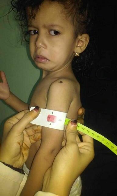 Im Jemenhilfe-Krankenhaus in Al Mihlaf werden  unterernährte Kinder erstversorgt. | Foto: Ali Al Sufi