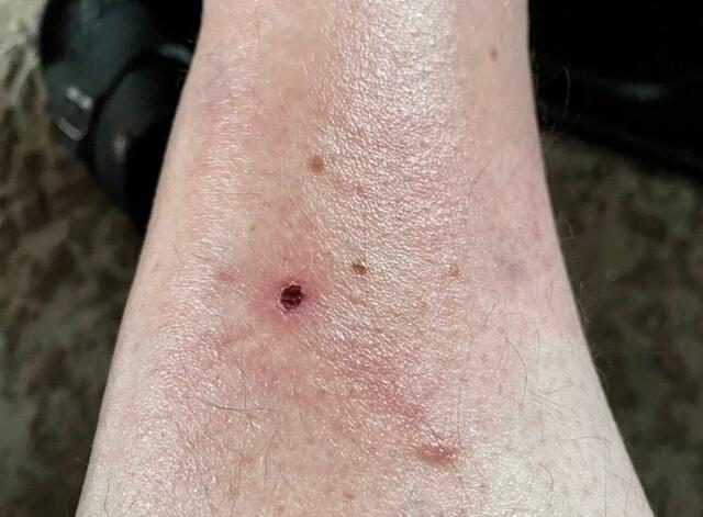 Die 10. WOCHE des Bisses