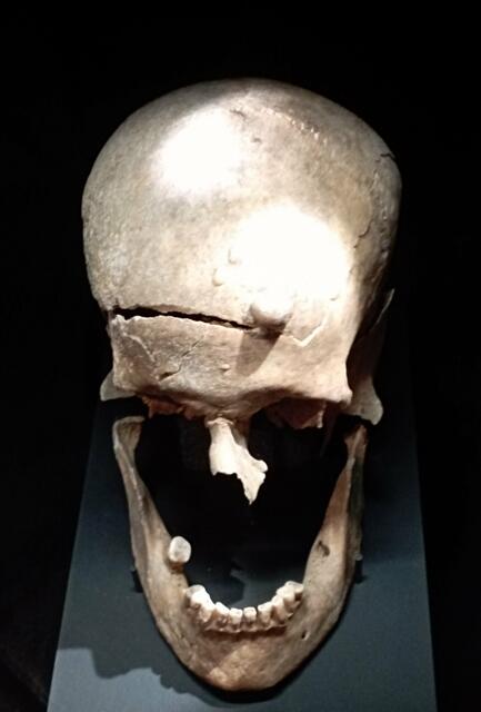 Osteome am Kopf der 45-50 jährigen Frau, deren Kopf abgetrennt vom Körper begraben wurde