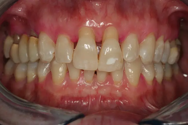 38-jährige Patientin mit Parodontitis-Erkrankung im Stadium III, Grad C

 
 | Foto: Prof. Dr. Peter Eickholz, Goethe-Universität Frankfurt